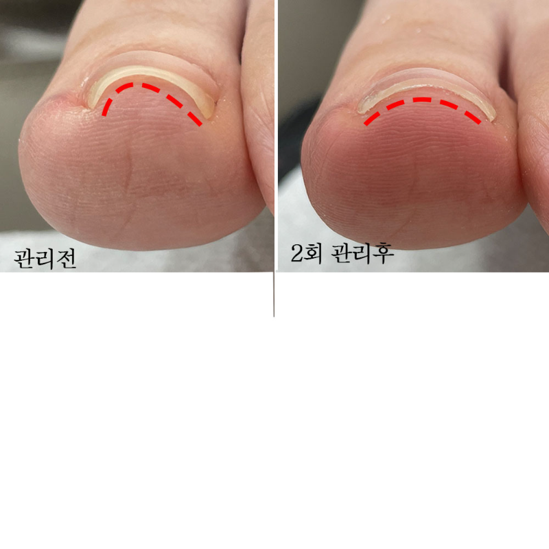 【riposo】3 types of Unfold Gel for ingrown toenails